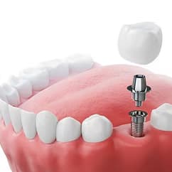 Dental Implants